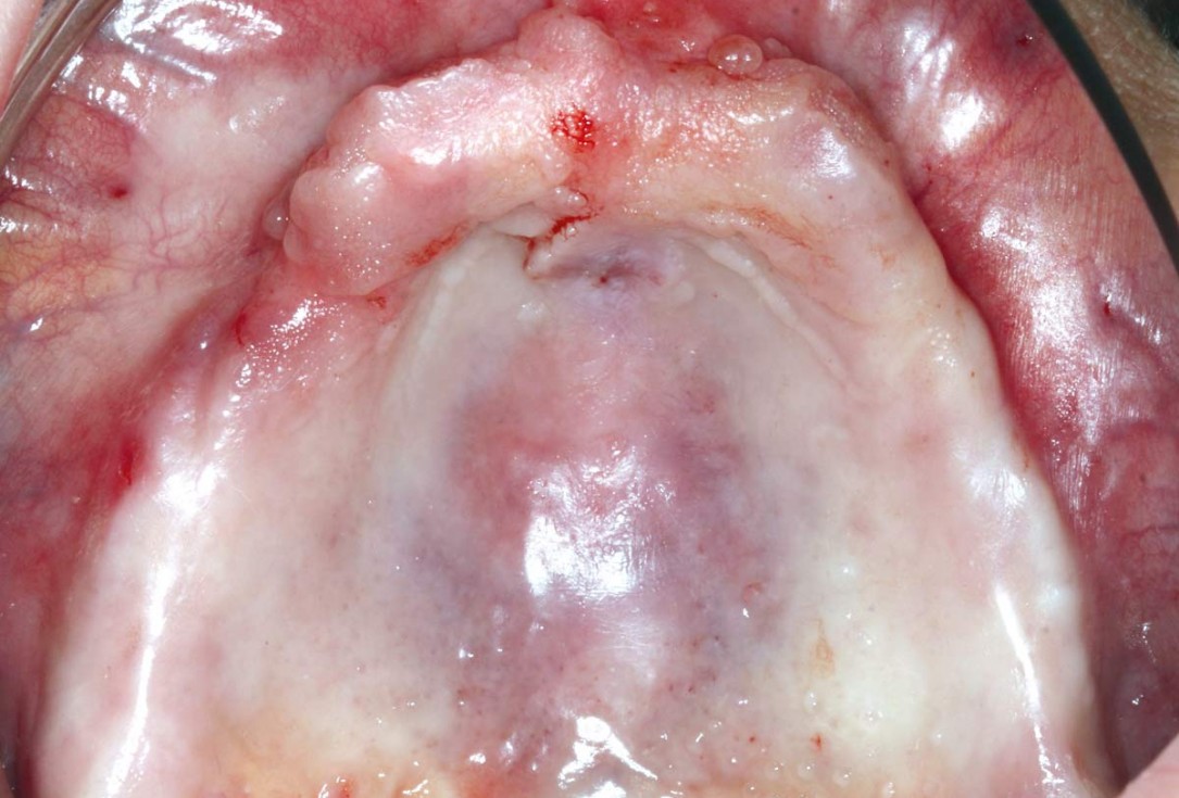 botiss maxgraft® bonebuilder for maxilla reconstruction - Clinical case