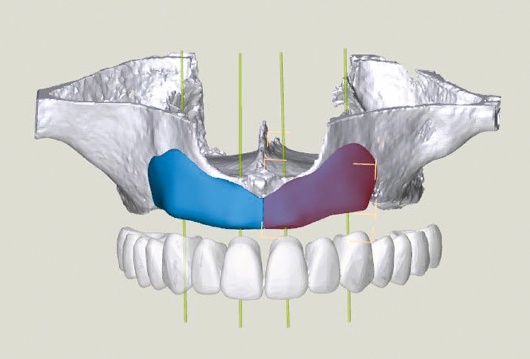 botiss maxgraft® bonebuilder for maxilla reconstruction - Clinical case