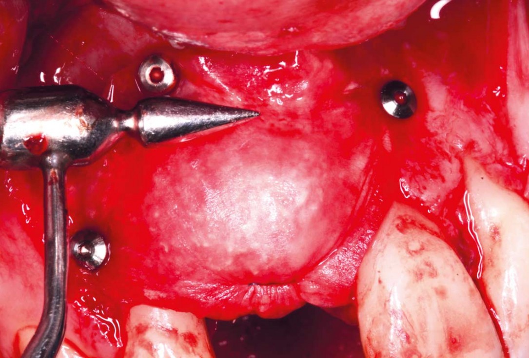 05/20 Delayed implant placement with GBR and soft tissue augmentation at the aesthetic area - 2 years follow up – Dr. H. Maghaireh & Dr. V. Ivancheva