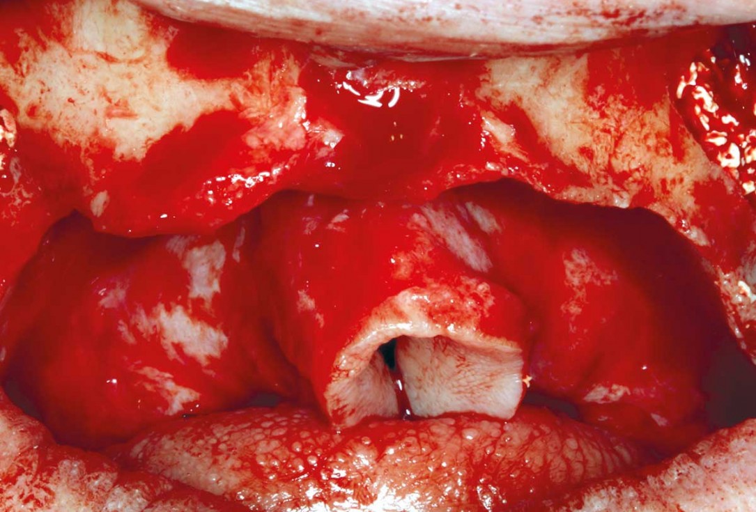 botiss maxgraft® bonebuilder for maxilla reconstruction - Clinical case