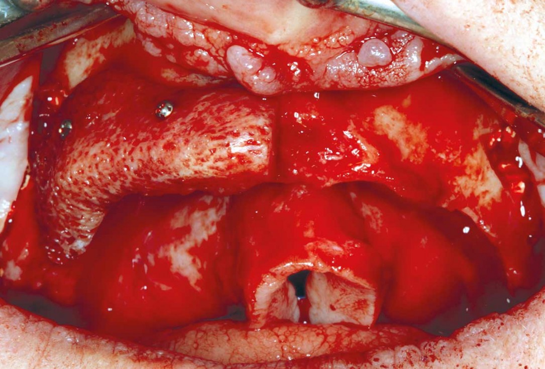 botiss maxgraft® bonebuilder for maxilla reconstruction - Clinical case