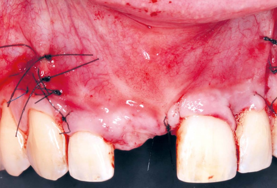 08/20 Delayed implant placement with GBR and soft tissue augmentation at the aesthetic area - 2 years follow up – Dr. H. Maghaireh & Dr. V. Ivancheva