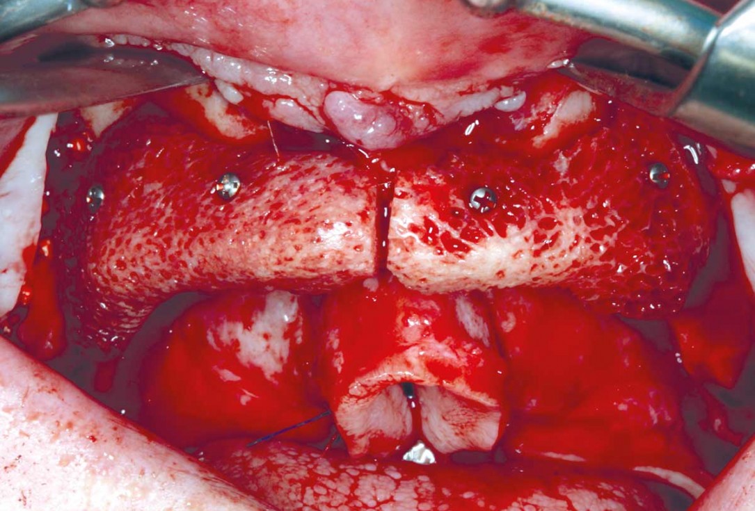 botiss maxgraft® bonebuilder for maxilla reconstruction - Clinical case