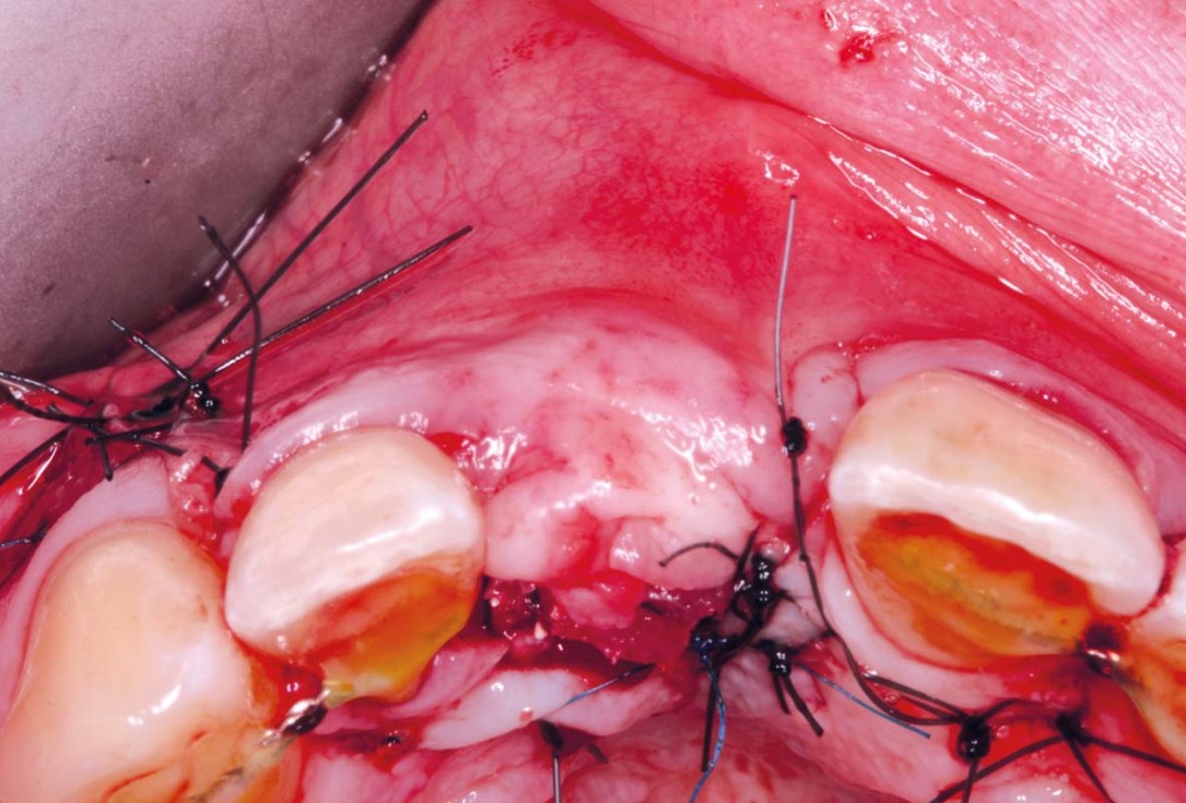 09/20 Delayed implant placement with GBR and soft tissue augmentation at the aesthetic area - 2 years follow up – Dr. H. Maghaireh & Dr. V. Ivancheva
