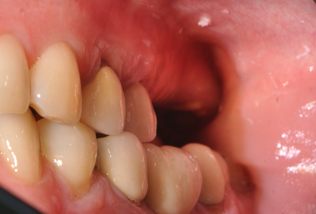 Sinus lift with simultaneous implantation with cerabone® and collprotect® membrane - clinical case Dr. Victor Kalenchuk