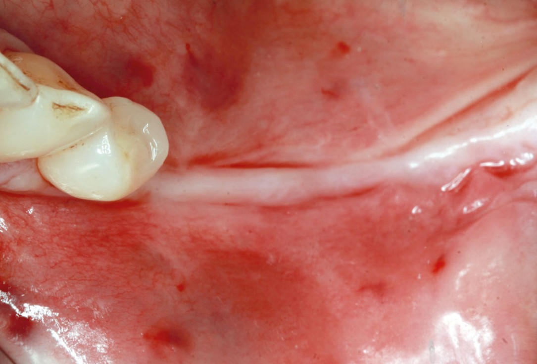 maxgraft® cortico at free-end situation in the mandible -  J. Kielhorn