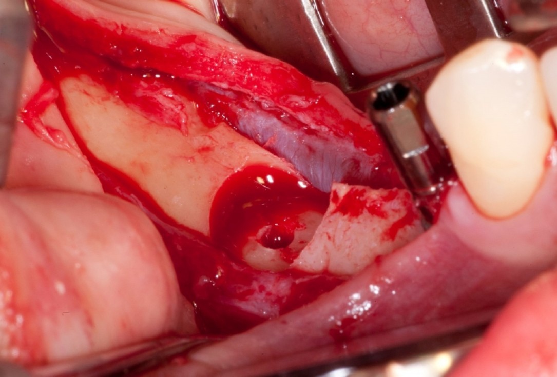 Vertical augmentation and sinus lift with maxgraft® bonering - Dr. O. Yüksel and Dr. B. Giesenhagen