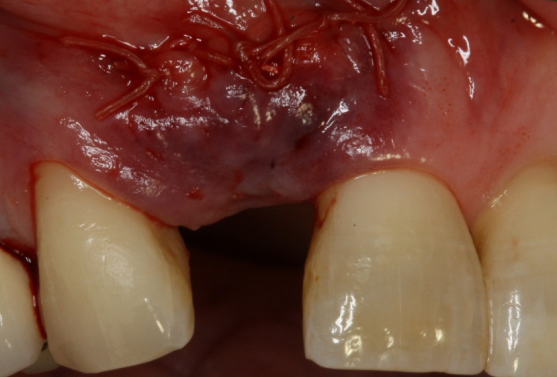 10/20 GBR with maxresorb® and Jason® membrane - Prof. Dr. Dr. D. Rothamel