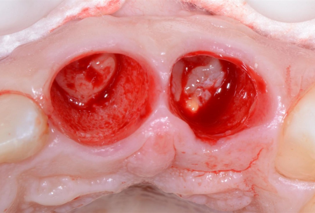 Ridge preservation with cerabone® Jason® membrane - Dr. D. Jelušić