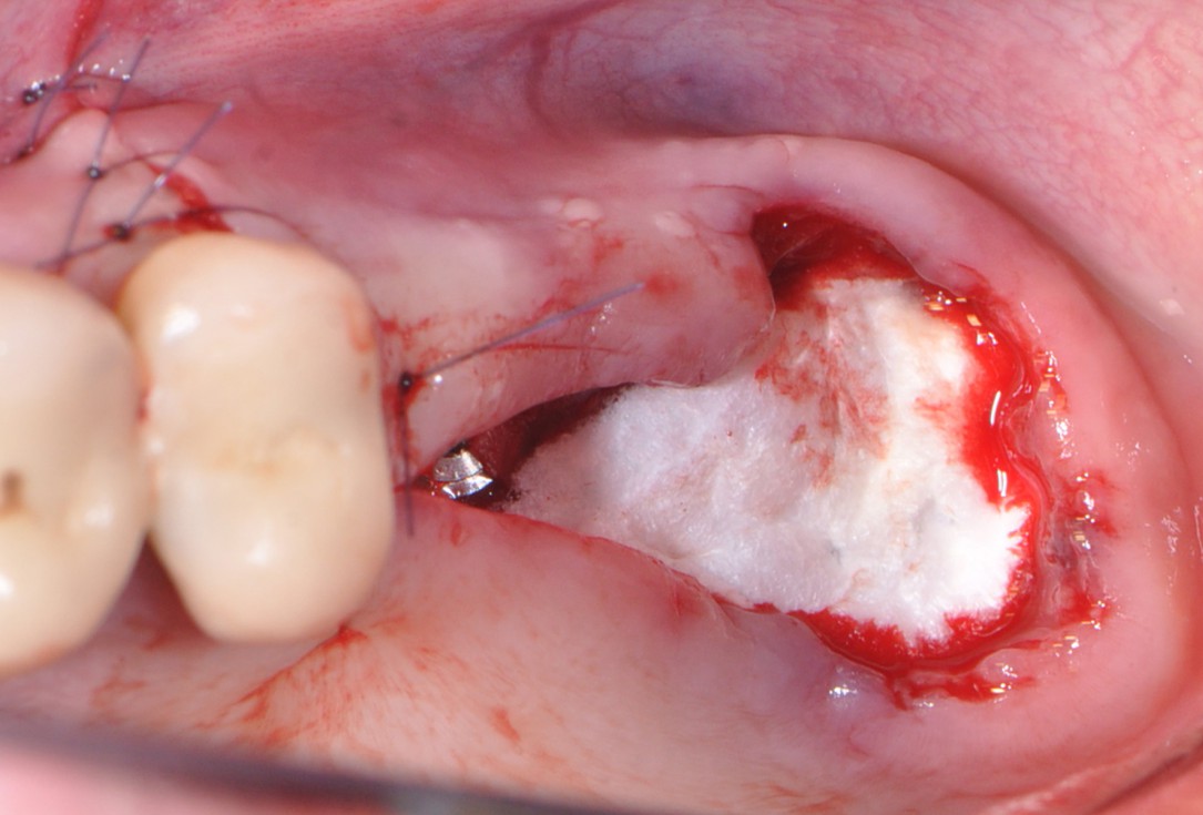 Sinus lift with simultaneous implantation with cerabone® and collprotect® membrane - clinical case Dr. Victor Kalenchuk