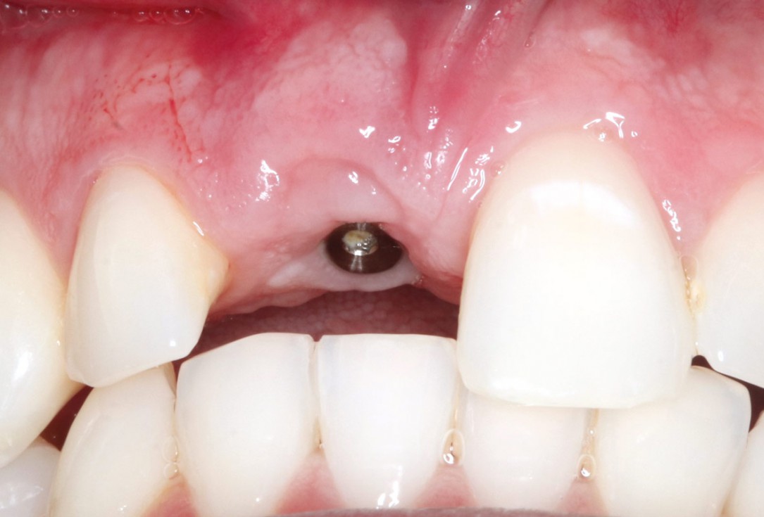Type II socket defect grafted and repaired in a flapless way using Jason® membrane and maxgraft® cortico-cancellous - Dr. A. Jones