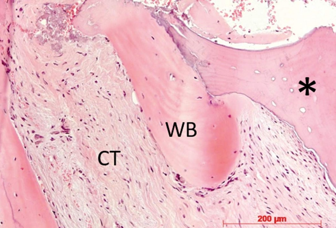 Horizontal ridge augmentation in the mandible with maxgraft® bonebuilder - Dr. O. Yüksel