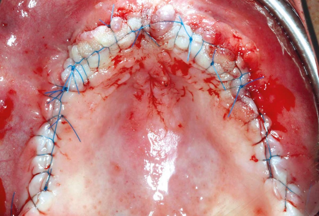botiss maxgraft® bonebuilder for maxilla reconstruction - Clinical case