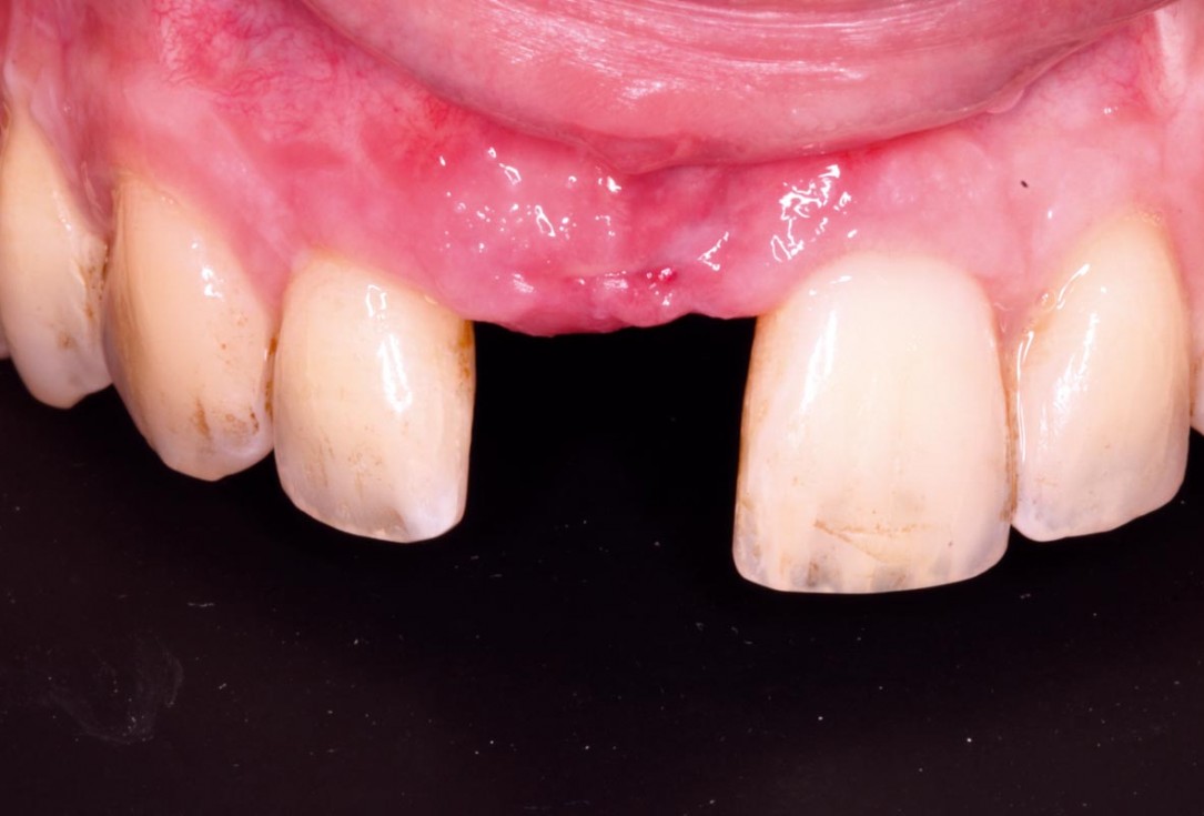 10/20 Delayed implant placement with GBR and soft tissue augmentation at the aesthetic area - 2 years follow up – Dr. H. Maghaireh & Dr. V. Ivancheva