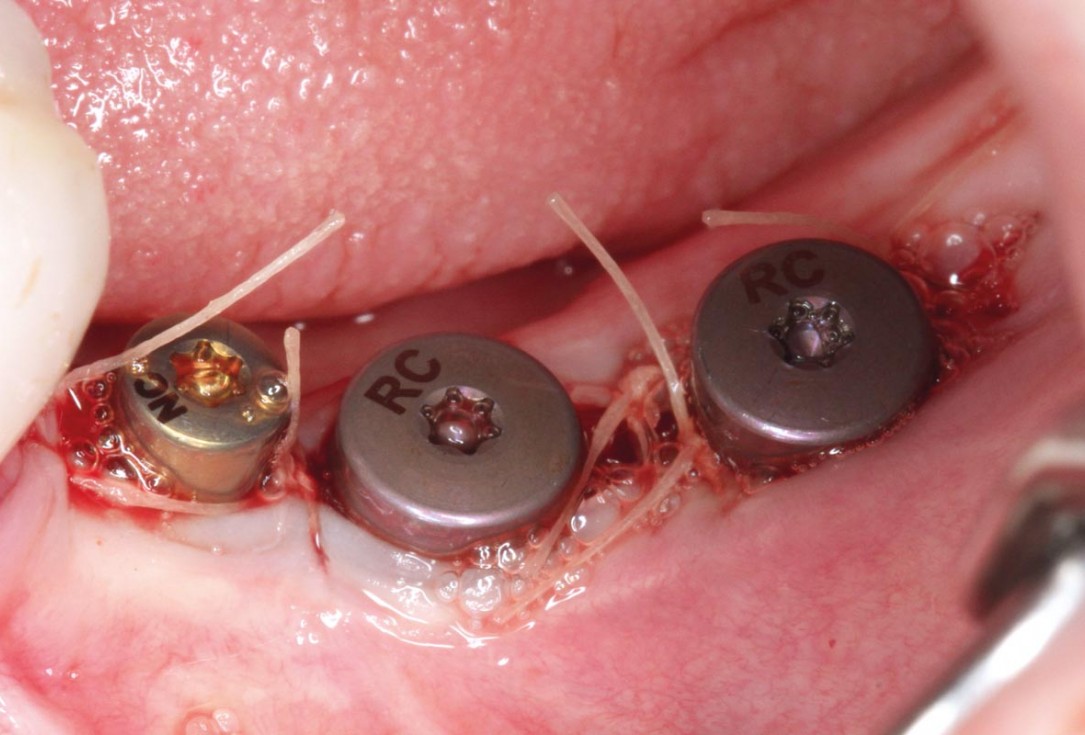 Ridge augmentation in the mandible with maxgraft® bonebuilder in a free-end situation - Dr. Dr. Dr. O. Blume
