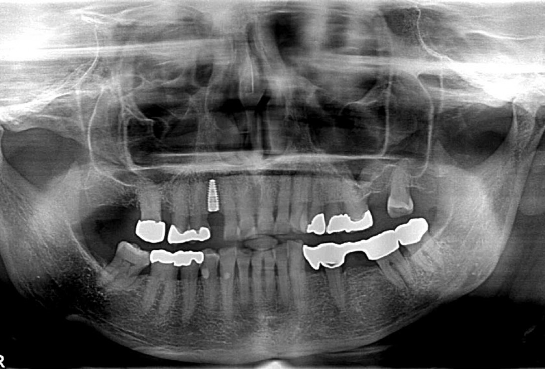 Block augmentation with maxgraft® in the maxilla - PD Dr. Dr. F. Kloss