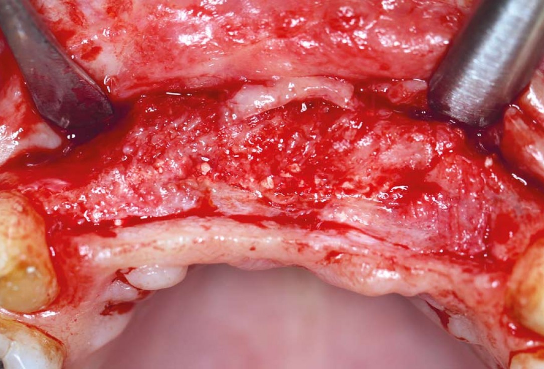botiss maxgraft® bonebuilder aesthetic reconstruction - Clinical case