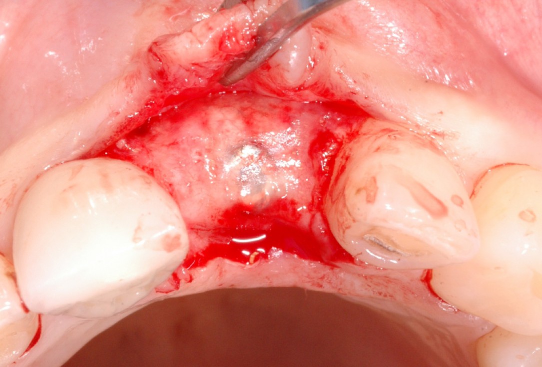 GBR together with soft tissue augmentation with mucoderm® and maxresorb® - Scherg