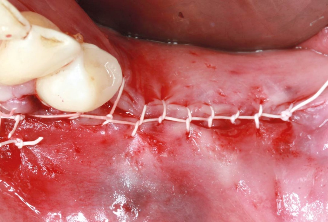maxgraft® cortico at free-end situation in the mandible - J. Kielhorn