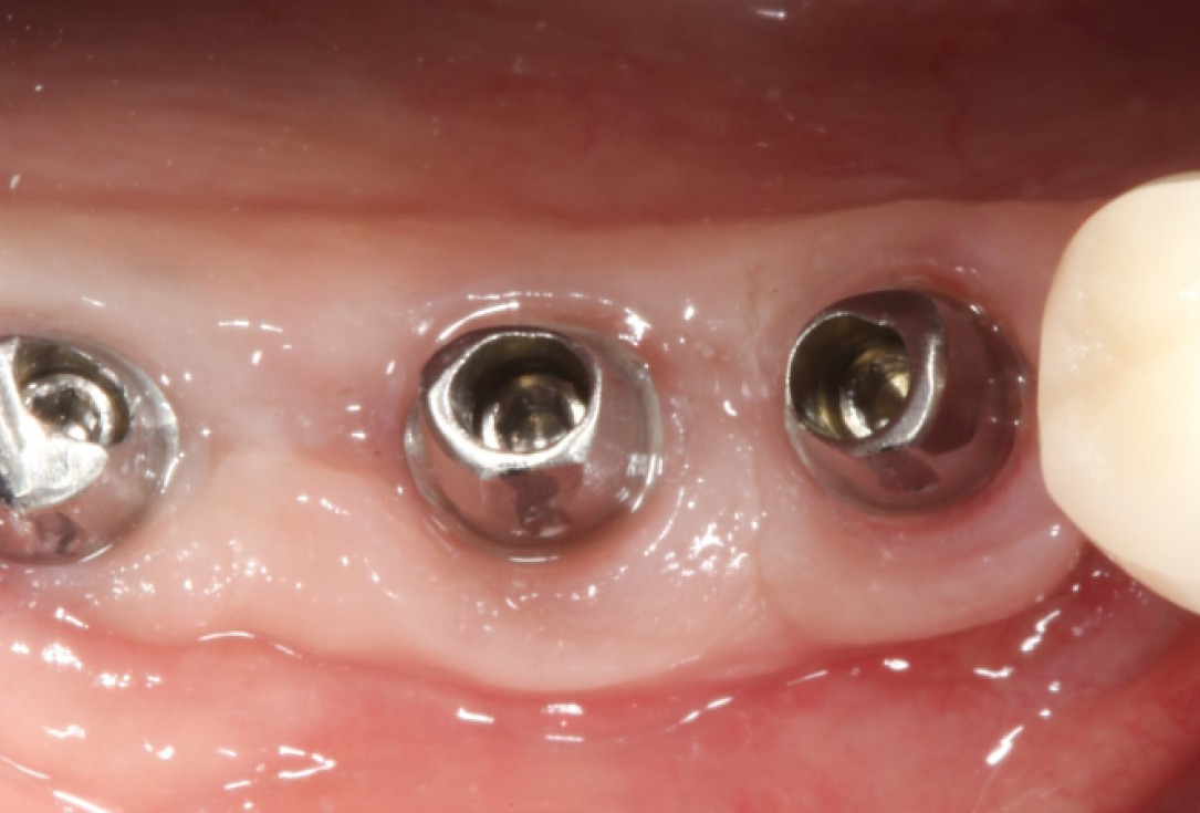 Ridge augmentation with maxgraft® bonebuilder - Dr. M. Jacotti