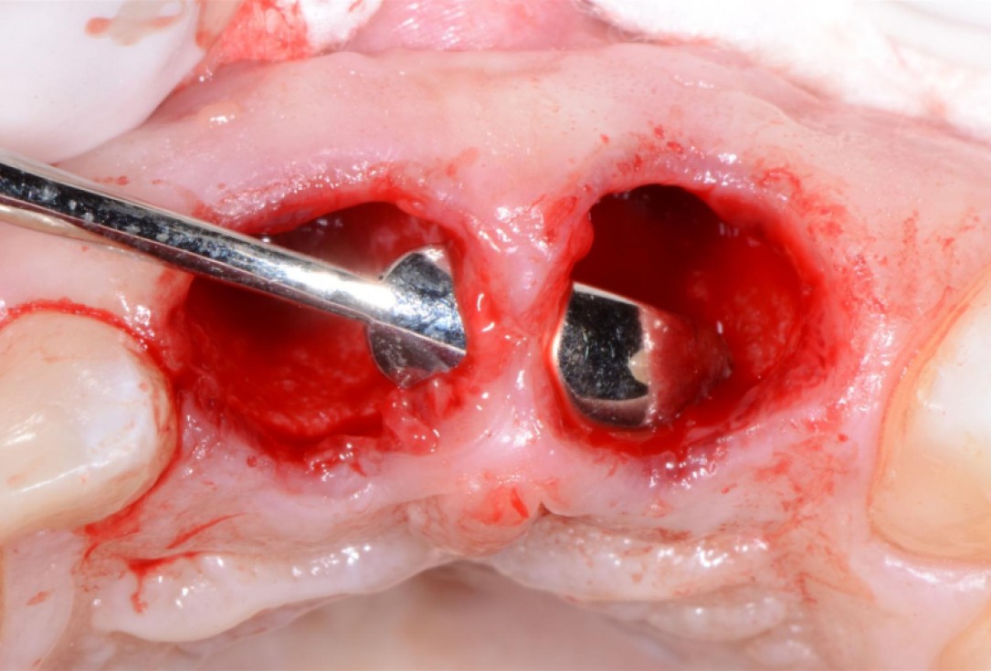 Ridge preservation with cerabone® Jason® membrane - Dr. D. Jelušić