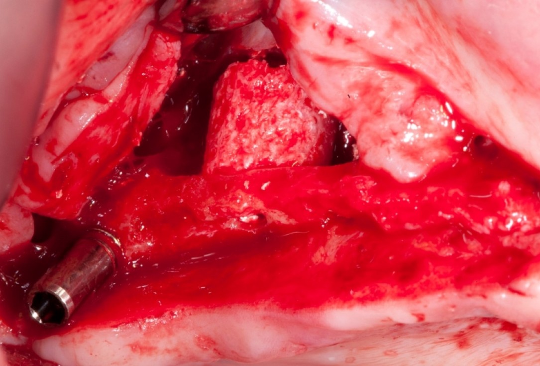 Vertical augmentation and sinus lift with maxgraft® bonering - Dr. O. Yüksel and Dr. B. Giesenhagen