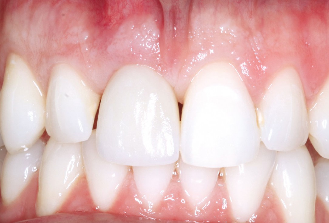 Type II socket defect grafted and repaired in a flapless way using Jason® membrane and maxgraft® cortico-cancellous - Dr. A. Jones