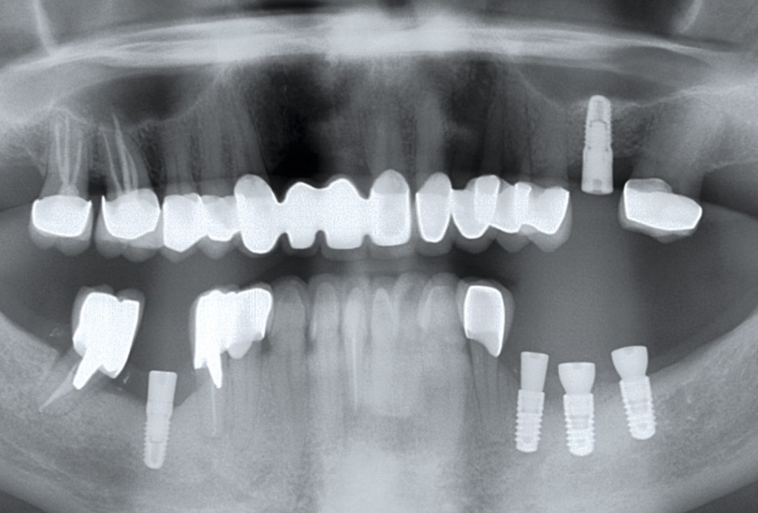 Ridge augmentation in the mandible with maxgraft® bonebuilder in a free-end situation - Dr. Dr. Dr. O. Blume
