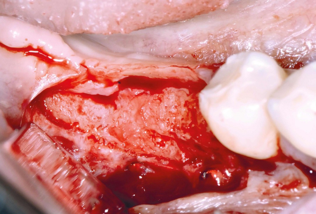 Ridge augmentation in the mandible with maxgraft® bonebuilder– Dr. R. Morger