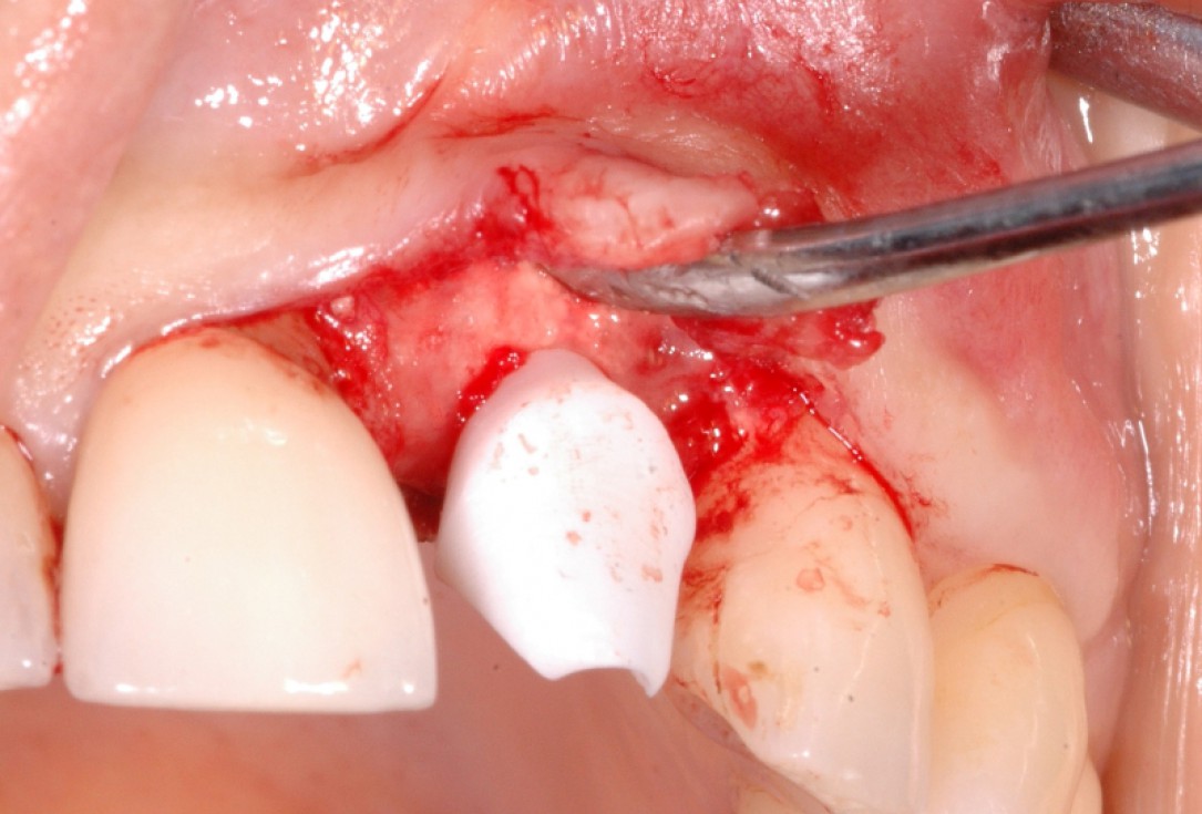 GBR together with soft tissue augmentation with mucoderm® and maxresorb® - Scherg