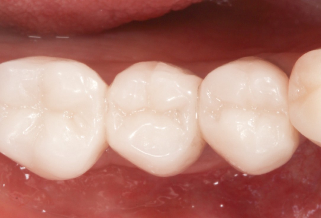 Ridge augmentation with maxgraft® bonebuilder - Dr. M. Jacotti
