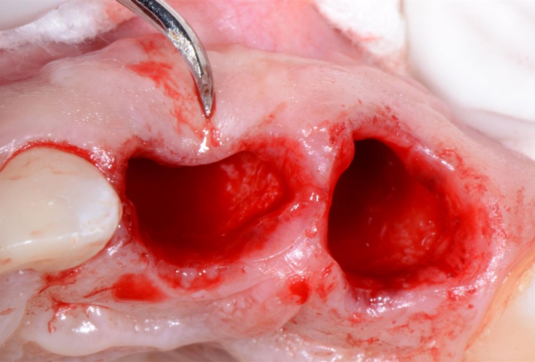 Ridge preservation with cerabone® Jason® membrane - Dr. D. Jelušić