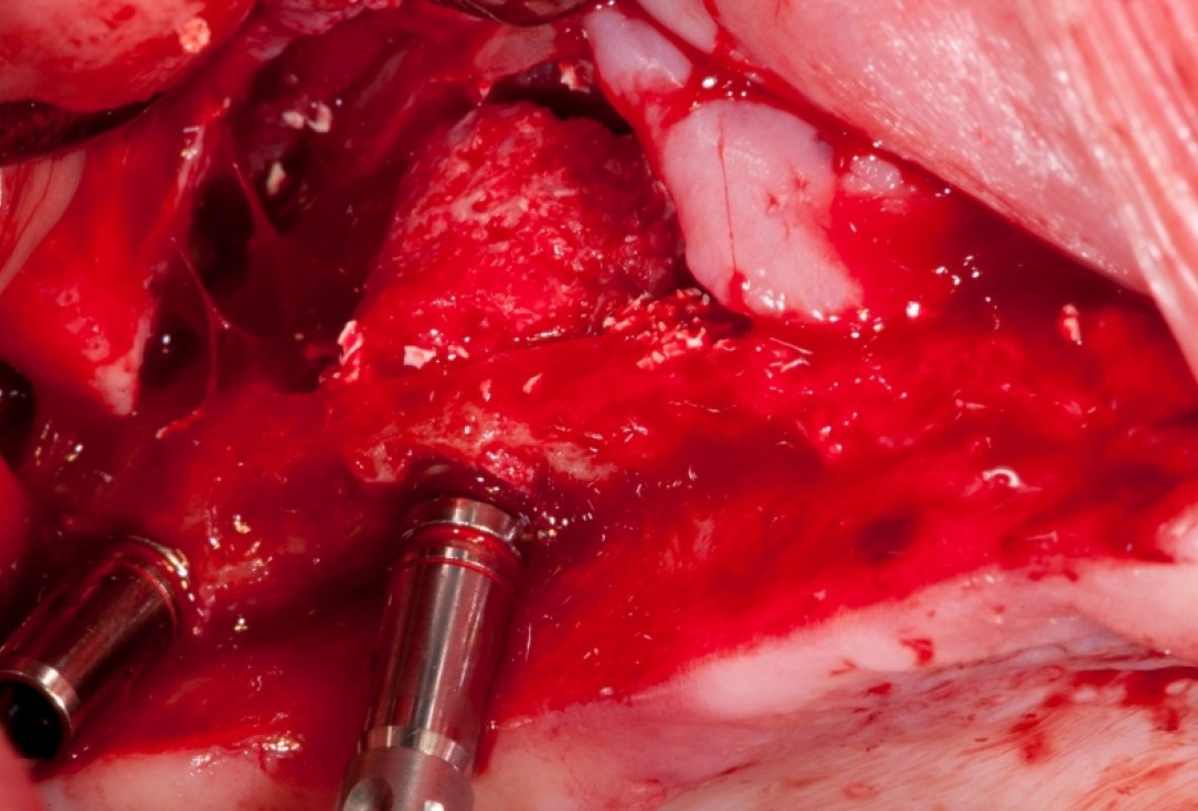 Vertical augmentation and sinus lift with maxgraft® bonering - Dr. O. Yüksel and Dr. B. Giesenhagen