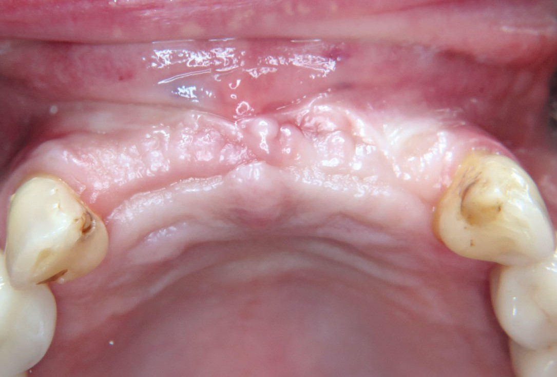 Three-dimensional augmentation with maxgraft® cortico - M.Sc. E. Kapogianni