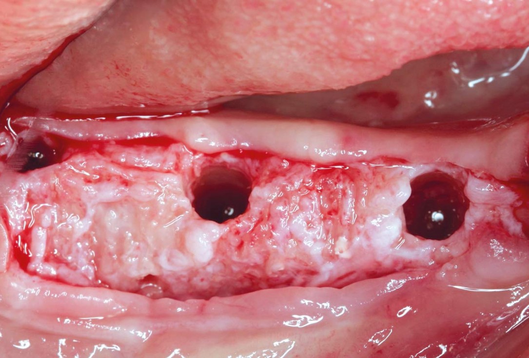 Horizontal ridge augmentation in the mandible with maxgraft® bonebuilder - Dr. O. Yüksel