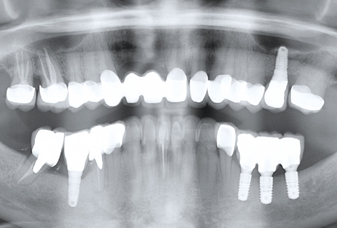 Ridge augmentation in the mandible with maxgraft® bonebuilder in a free-end situation - Dr. Dr. Dr. O. Blume