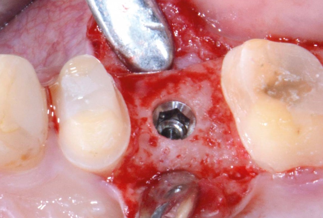 Full bone regeneration in extraction socket augmented with maxgraft® and Jason® membrane – Dr. C. Landsberg