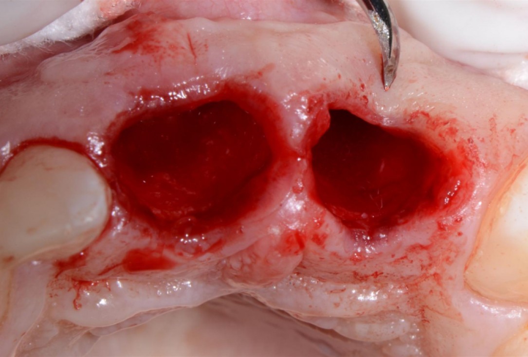 Ridge preservation with cerabone® Jason® membrane - Dr. D. Jelušić