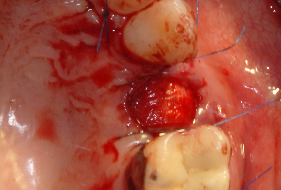 Ridge preservation with cerabone® and Jason® membrane - Dr. Derk Siebers