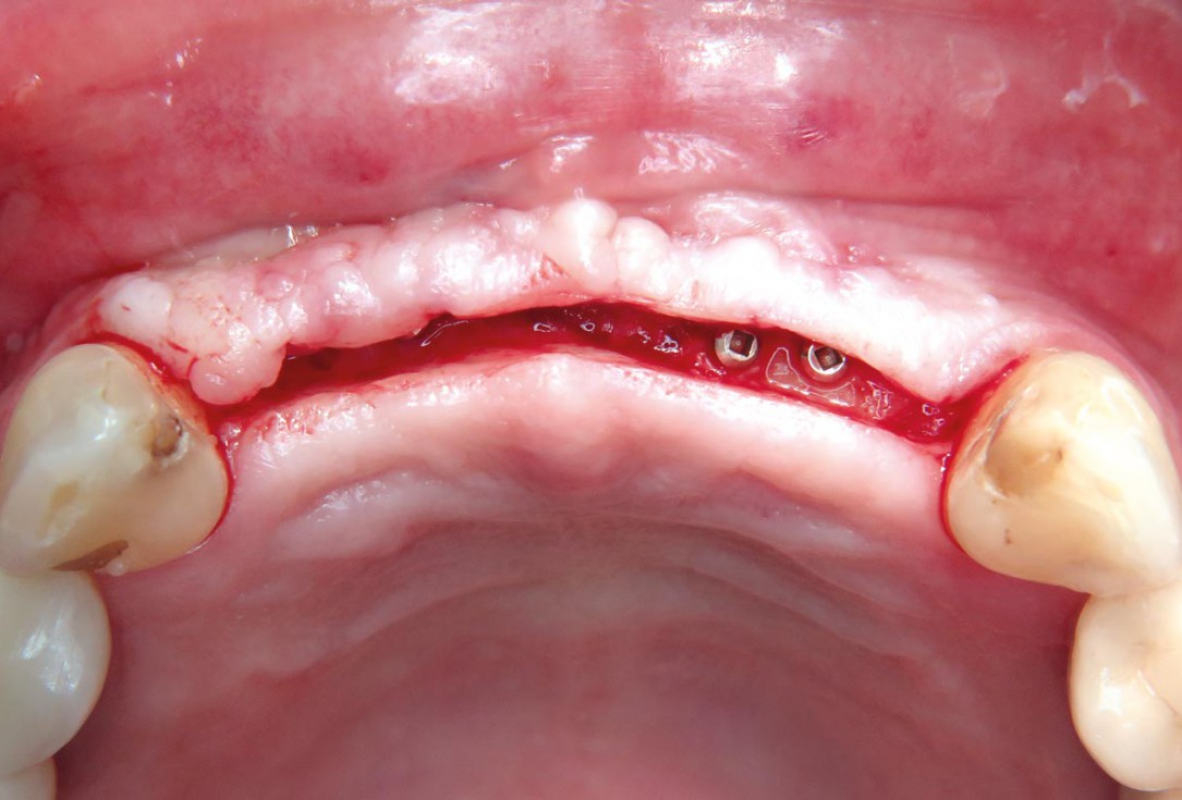 Three-dimensional augmentation with maxgraft® cortico - M.Sc. E. Kapogianni