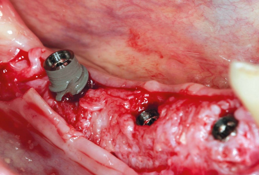 Horizontal ridge augmentation in the mandible with maxgraft® bonebuilder - Dr. O. Yüksel