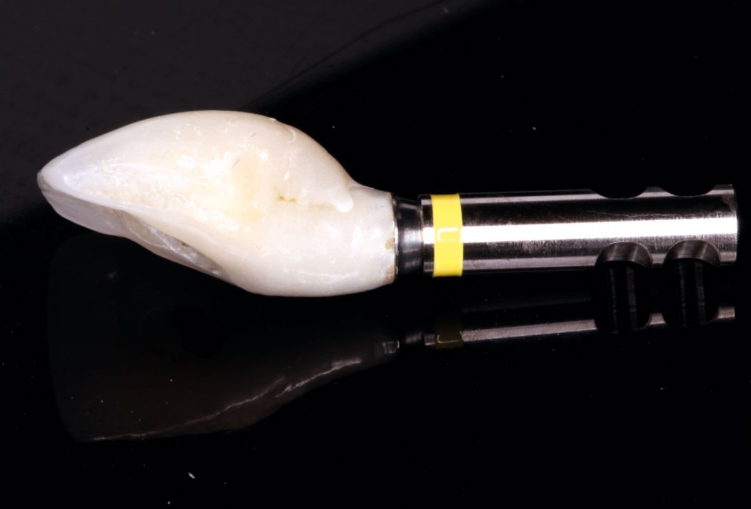 13/20 Delayed implant placement with GBR and soft tissue augmentation at the aesthetic area - 2 years follow up – Dr. H. Maghaireh & Dr. V. Ivancheva