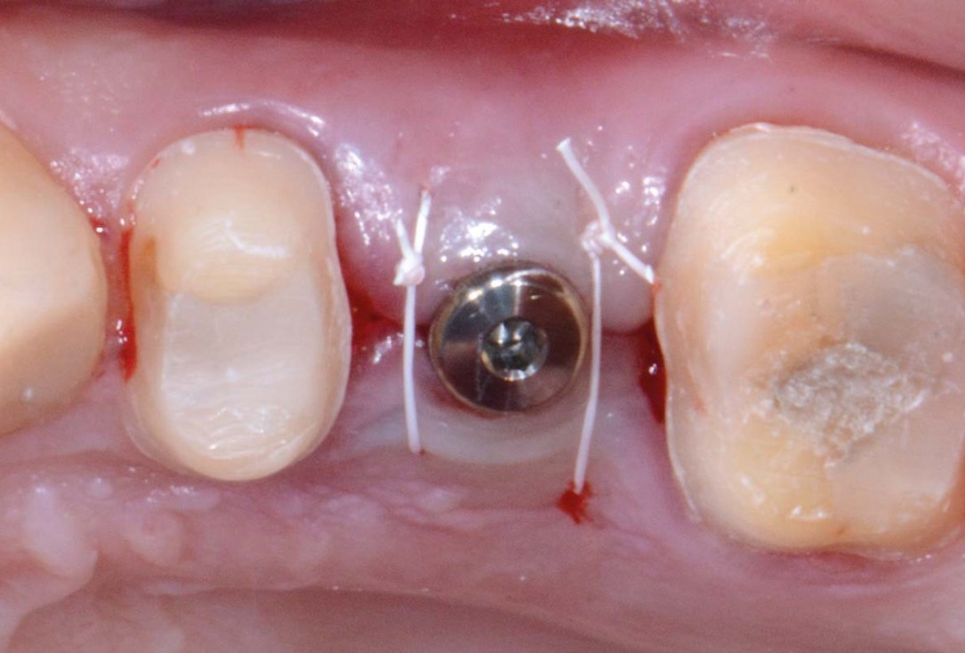 Full bone regeneration in extraction socket augmented with maxgraft® and Jason® membrane – Dr. C. Landsberg