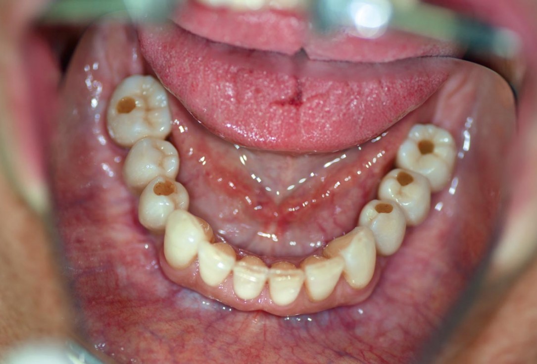 botiss maxgraft® bonebuilder for mandibular reconstruction - Clinical case