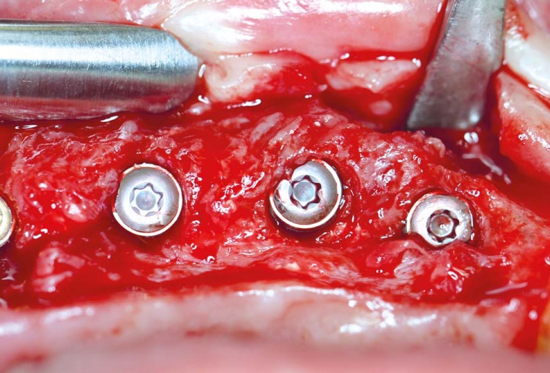 botiss maxgraft® bonebuilder aesthetic reconstruction - Clinical case