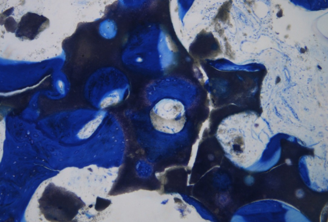 14/20 GBR with maxresorb® and Jason® membrane - Prof. Dr. Dr. D. Rothamel