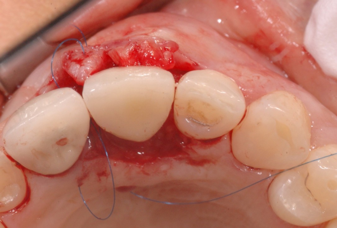 GBR together with soft tissue augmentation with mucoderm® and maxresorb® - Scherg