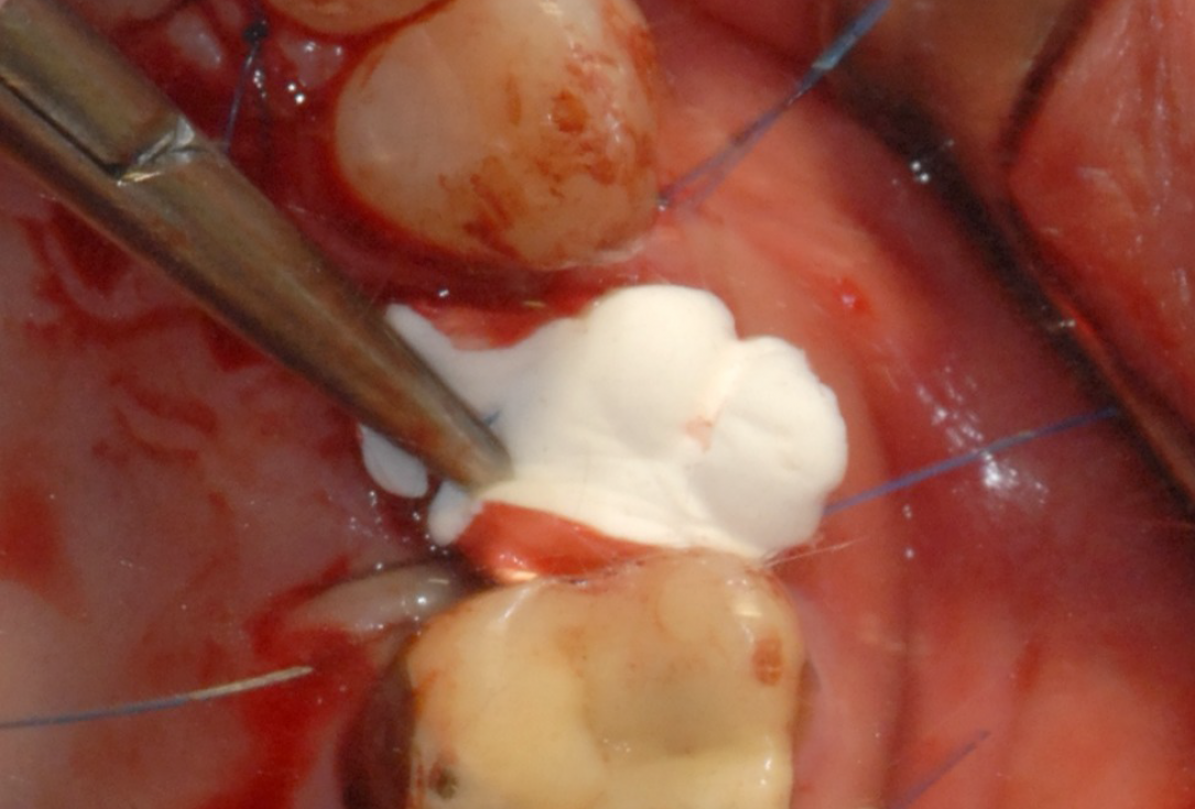 Ridge preservation with cerabone® and Jason® membrane - Dr. Derk Siebers