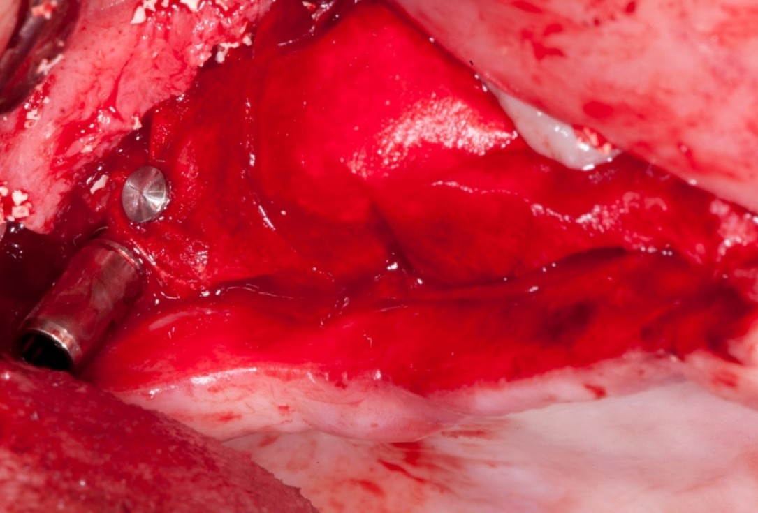 Vertical augmentation and sinus lift with maxgraft® bonering - Dr. O. Yüksel and Dr. B. Giesenhagen