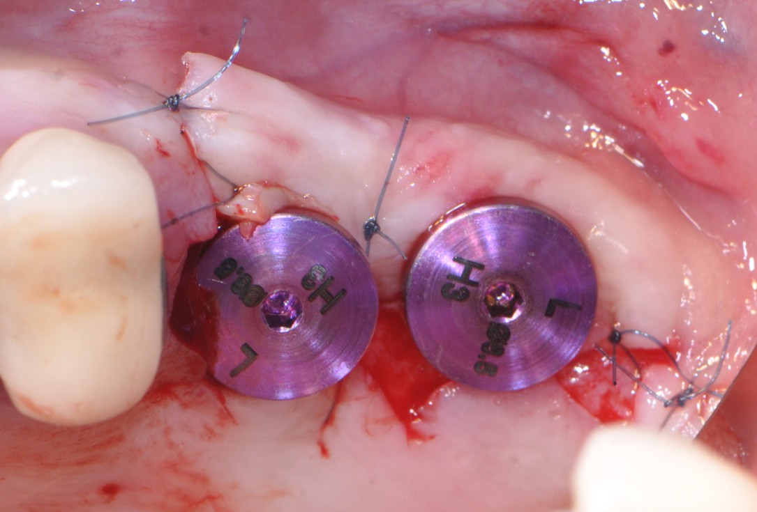 Sinus lift with simultaneous implantation with cerabone® and collprotect® membrane - clinical case Dr. Victor Kalenchuk